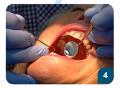 Nhổ răng không đau tại Thanh Hóa - Nha khoa Dr. Hiếu Thanh Hóa